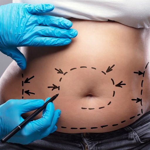 Karın Germe - Prof. Dr. Cüneyt Özek