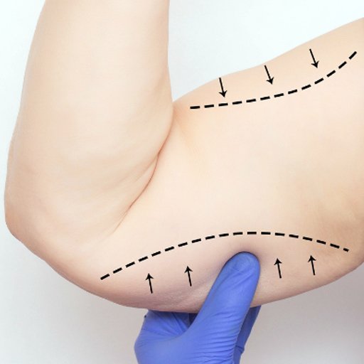 Brakioplasti - Prof. Dr. Cüneyt Özek