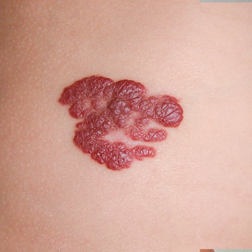 Hemanjiom - Prof. Dr. Cüneyt Özek