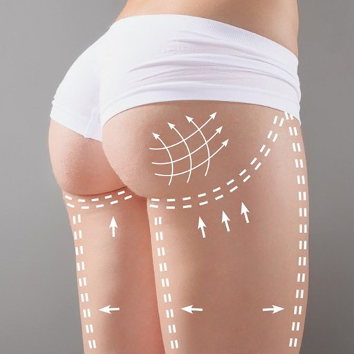 Popo & Kalça Estetiği - Prof. Dr. Cüneyt Özek